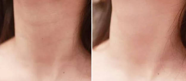 嗨體去頸紋幾天有效果 嗨體去頸紋如何延長維持時間