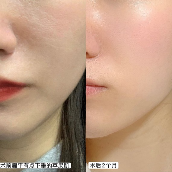 少女針是什么？少女針和玻尿酸填充哪個(gè)好？