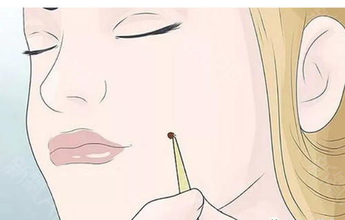 激光點痣要多久才會恢復？激光點痣多少錢？