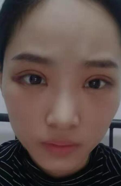  長沙星雅醫(yī)療美容醫(yī)院做雙眼皮手術(shù)后恢復(fù)情況