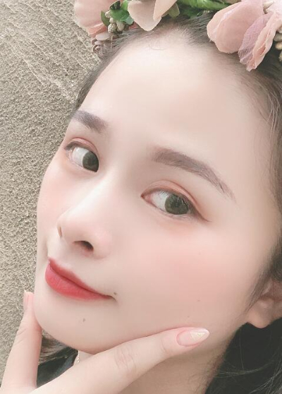 長(zhǎng)春中妍醫(yī)療美容醫(yī)院做雙眼皮手術(shù)后第50天