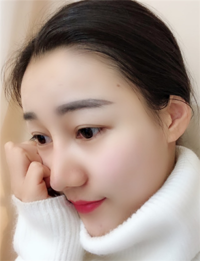 長(zhǎng)春中妍醫(yī)療美容醫(yī)院王軍隆鼻案例效果分享