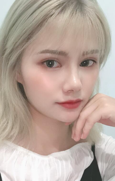 長(zhǎng)春亞韓醫(yī)學(xué)美容醫(yī)院做面部吸脂手術(shù)后的臉部