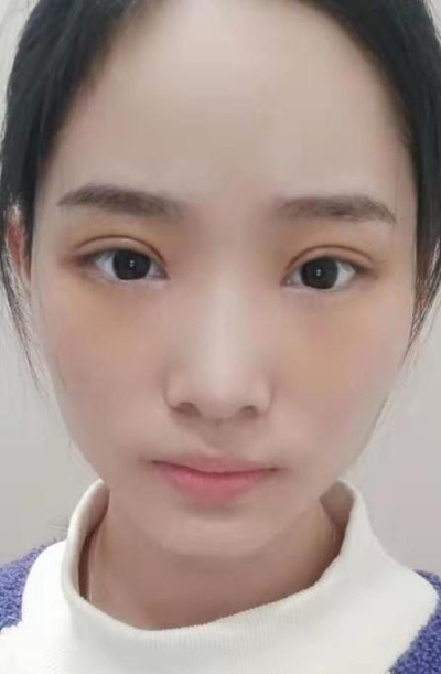  長沙星雅醫(yī)療美容醫(yī)院做雙眼皮的最終手術(shù)效果