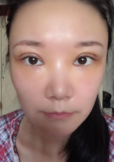  寧波尚美整形美容醫(yī)院做雙眼皮手術(shù)后的頭幾天