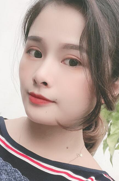 長(zhǎng)春中妍醫(yī)療美容醫(yī)院做雙眼皮手術(shù)后第85天