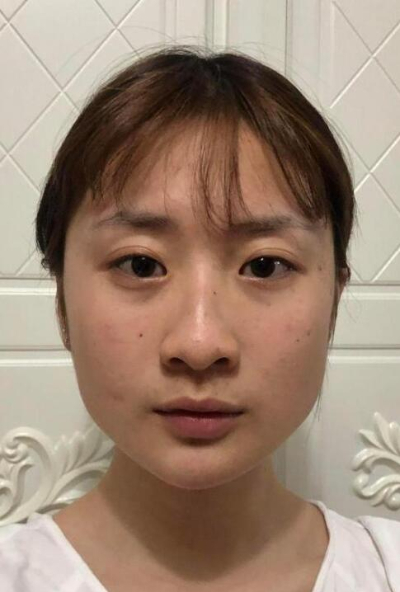 珠海陸達(dá)美容外科醫(yī)院陳越文下頜骨案例效果分享