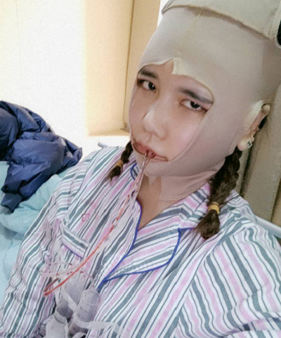 上海藝星醫(yī)療美容醫(yī)院做顴骨降低手術(shù)剛剛結(jié)束后