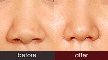 成都菲爾整形做鼻翼縮小術(shù)怎么樣？鼻翼縮小術(shù)安全嗎？