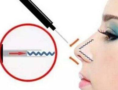 成都博雅整形埋線隆鼻有哪些優(yōu)勢(shì)？成都博雅埋線隆鼻疼嗎？