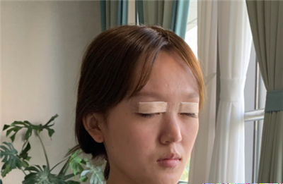 慈溪悅爾醫(yī)學(xué)美容醫(yī)院做雙眼皮手術(shù)剛剛結(jié)束 慈溪悅爾醫(yī)學(xué)美容醫(yī)院做雙眼皮手術(shù)剛剛結(jié)束