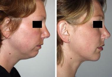 成都當(dāng)代整形透明質(zhì)酸墊下巴效果？ 透明質(zhì)酸墊下巴多少錢？