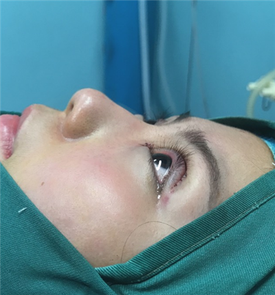 溫州友好醫(yī)院整形美容中心做雙眼皮手術剛剛結束