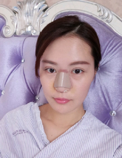 寧波尚美整形美容醫(yī)院齊強(qiáng)鼻綜合案例效果分享