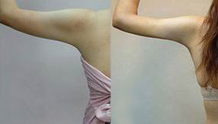  成都春語(yǔ)整形做手臂吸脂治術(shù)后效果好嗎？