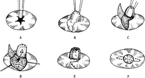成都韓美醫(yī)療做巨乳縮小術效果如何有多少方法？