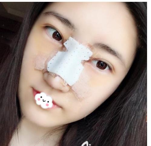 長春亞韓整形假體隆鼻案例術(shù)后兩天