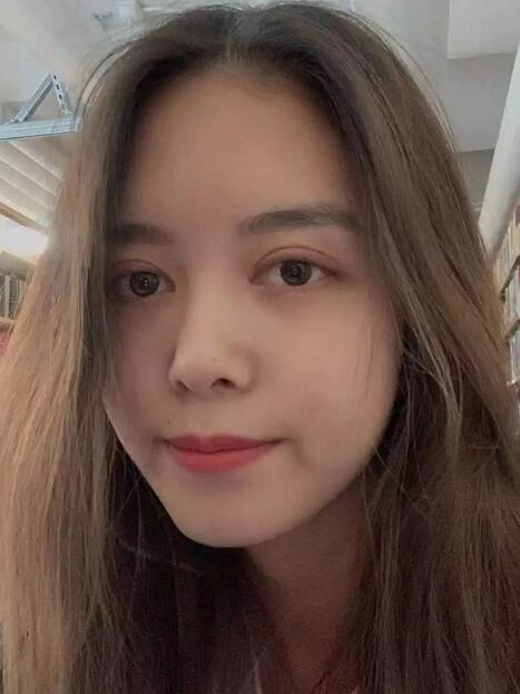 做雙眼皮案例，鄭州壹加壹王洛生全切雙眼皮案例圖片