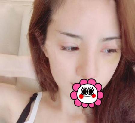 宜昌奧萊整形楊群申膨體隆鼻案例術(shù)后十天效果 宜昌奧萊整形楊群申膨體隆鼻案例術(shù)后十天效果