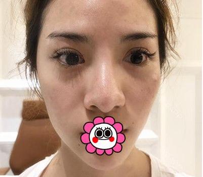 宜昌奧萊整形楊群申膨體隆鼻案例術(shù)前效果 宜昌奧萊整形楊群申膨體隆鼻案例術(shù)前效果