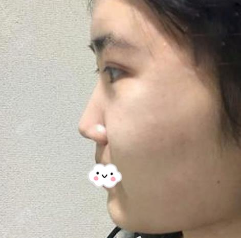 長春亞韓整形假體隆鼻案例術(shù)前側(cè)面