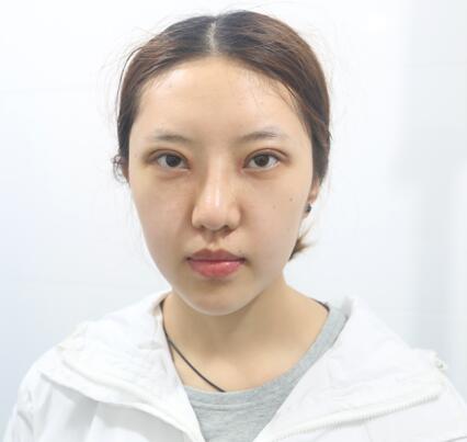 第四軍醫(yī)大學唐都醫(yī)院李望舟雙眼皮案例術后一周