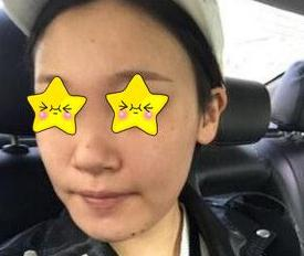 隆鼻真實(shí)案例，長沙亞韓鄭京湘隆鼻前后對(duì)比圖片