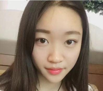 宜昌奧萊楊群申超體隆鼻案例術(shù)前