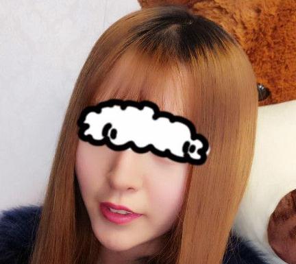 北京聯(lián)合麗格卓彥醫(yī)療趙瓊隆鼻失敗修復(fù)手術(shù)案例術(shù)后一個半月