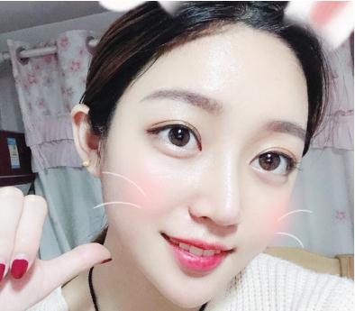 宜昌奧萊楊群申超體隆鼻案例術(shù)后兩個(gè)月