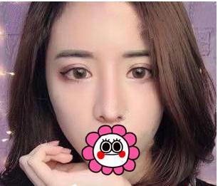 宜昌奧萊整形楊群申膨體隆鼻案例術(shù)后兩個(gè)月效果 宜昌奧萊整形楊群申膨體隆鼻案例術(shù)后兩個(gè)月效果