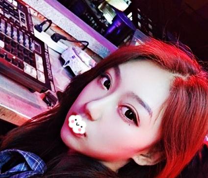 在上海伊美爾港華做假體隆鼻術(shù)后一個月效果