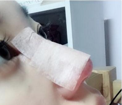 宜昌奧萊楊群申超體隆鼻案例術(shù)后兩天