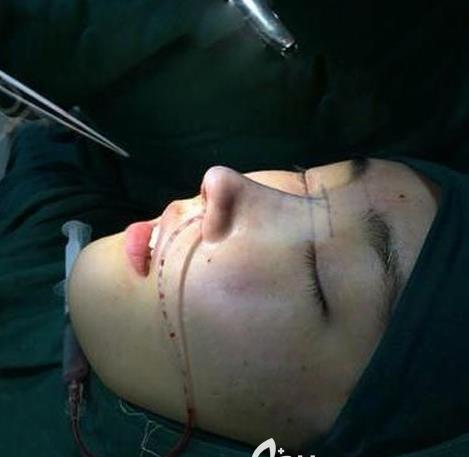 長春亞韓整形假體隆鼻案例術(shù)后即刻側(cè)面