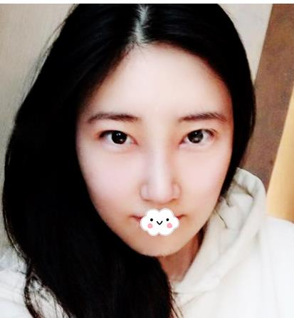 假體隆鼻假嗎？假體隆鼻三個(gè)月效果分享