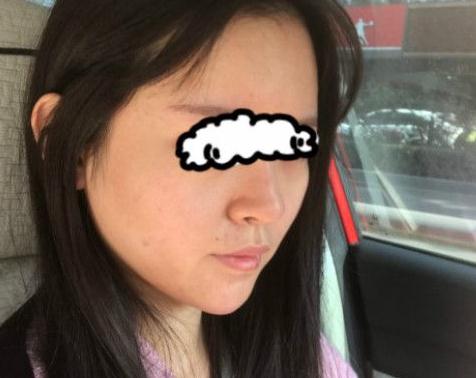 北京聯(lián)合麗格卓彥醫(yī)療趙瓊隆鼻失敗修復(fù)手術(shù)案例術(shù)后半個月