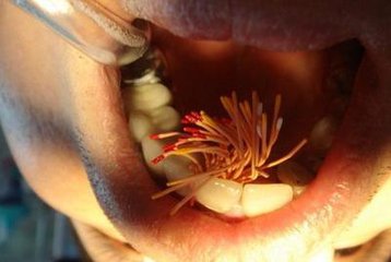 撫州英倫口腔根管治療怎么樣？根管治療有什么優(yōu)點(diǎn)？