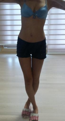 東莞華美醫(yī)療美容醫(yī)院做腰腹吸脂手術后的最終情況