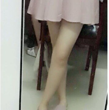 東莞華美醫(yī)療美容醫(yī)院劉江做大腿吸脂案例效果分享