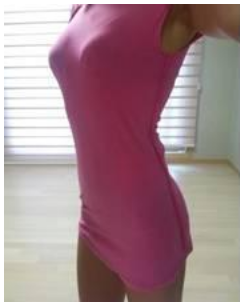 東莞華美醫(yī)療美容醫(yī)院做腰腹吸脂術后的腰部