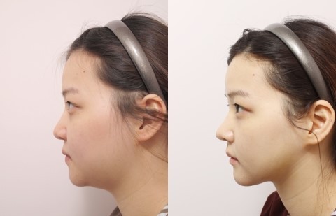 面部吸脂最好的辦法是什么？做一次面部吸脂多少錢？