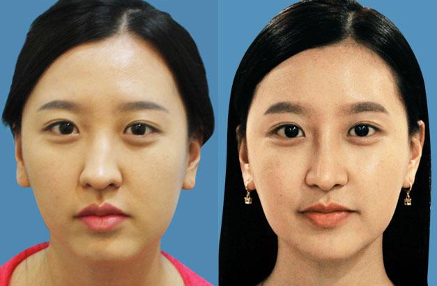 面部不對稱可以怎么矯正？臉一邊大一邊小怎么矯正？