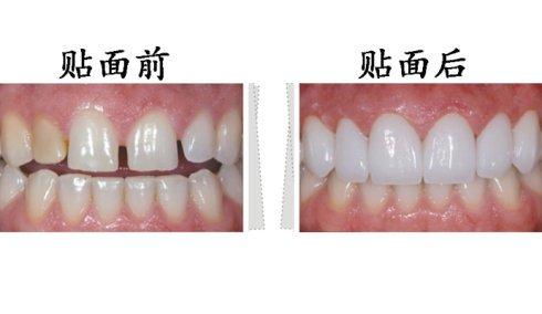 東莞拜博口腔瓷貼面有什么優(yōu)勢？瓷貼面有副作用嗎？