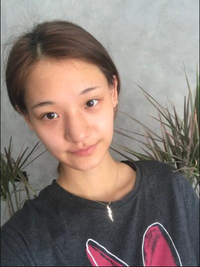 成都蜀尚蓉雅美容整形醫(yī)院做鼻綜合術(shù)前的鼻子 成都蜀尚蓉雅美容整形醫(yī)院做鼻綜合術(shù)前的鼻子