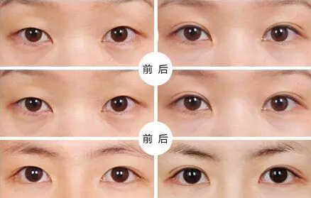 貴州旭美人整形埋線雙眼皮優(yōu)點(diǎn)有哪些如何選擇？