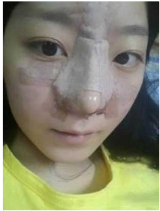 上海時(shí)光整形外科醫(yī)院做耳軟骨隆鼻術(shù)后剛剛結(jié)束