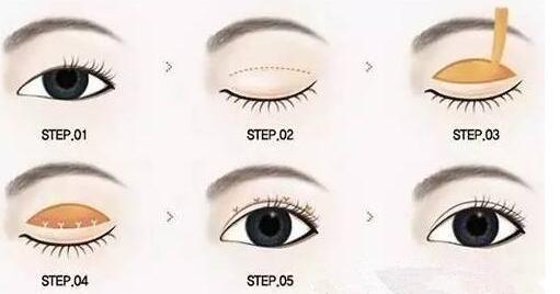 哈爾濱第一醫(yī)院切開(kāi)雙眼皮多少錢？切開(kāi)雙眼皮如何恢復(fù)？