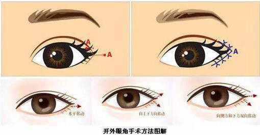 桂林嘉美醫(yī)療開外眼角是什么？開外眼角適用人群？
