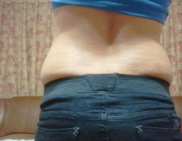 東莞華美醫(yī)療美容醫(yī)院做腰腹吸脂手術前的腰