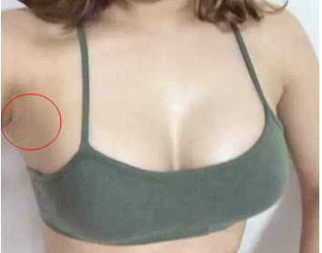 南京美貝爾醫(yī)療美容醫(yī)院做假體隆胸手術(shù)后的一個月 南京美貝爾醫(yī)療美容醫(yī)院做假體隆胸手術(shù)后的一個月